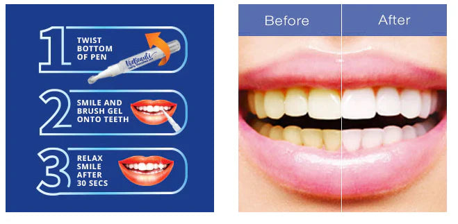 Dazzle Teeth Whitening Pen Tooth Gel